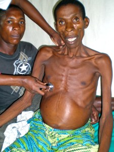 Patient with abdominal Tuberculosis