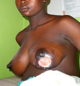 Breast infection from nursing