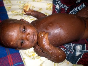 Infant with Steven-Johnson Syndrome