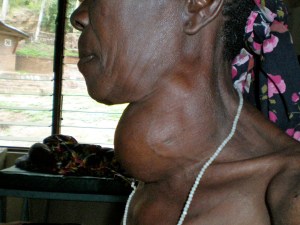 Woman with Goiter